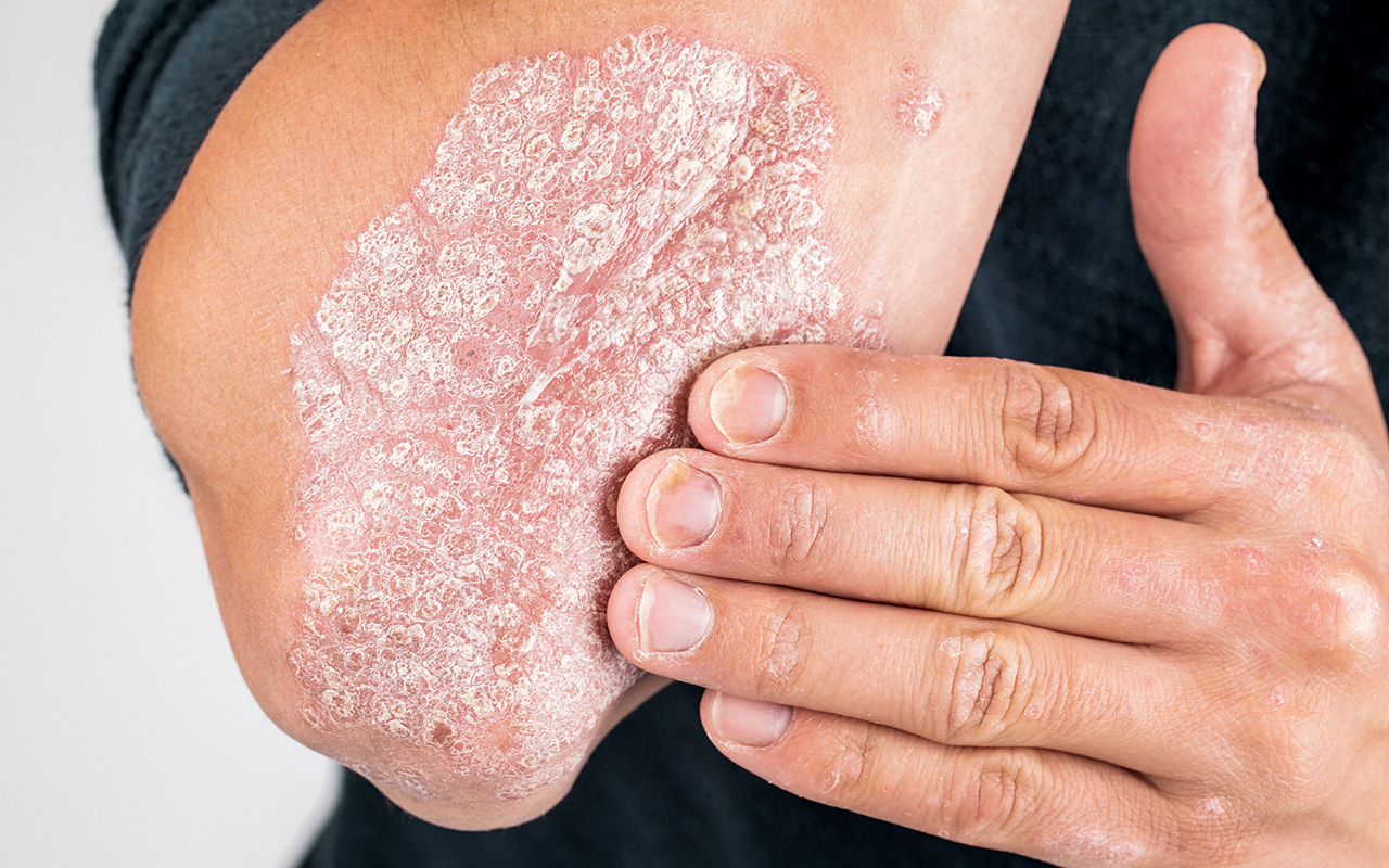 MJA Podcasts 2020 Episode 18 Psoriasis and its